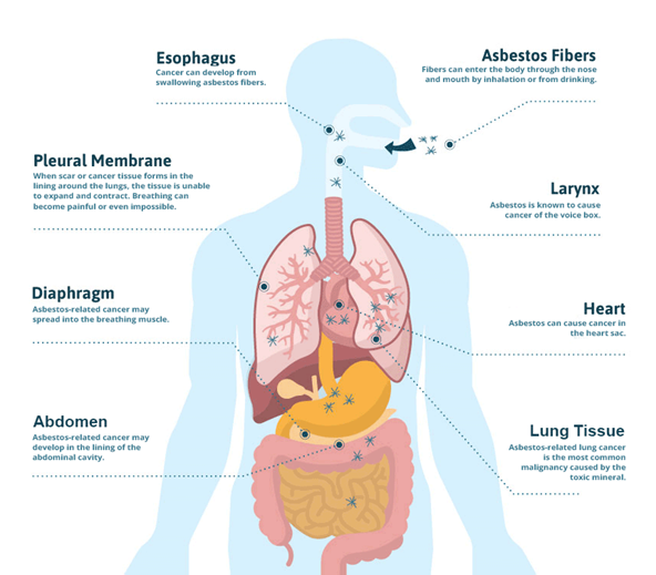 Body drawing showing asbestos related deseases